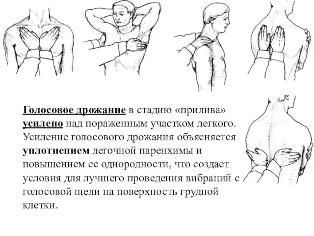 Голосовое дрожание в стадию «прилива» усилено над пораженным участком легкого. Усиление