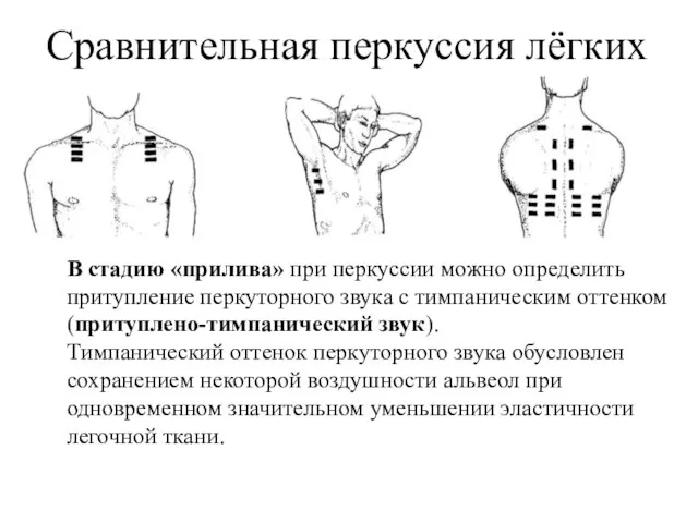 Сравнительная перкуссия лёгких В стадию «прилива» при перкуссии можно определить притупление