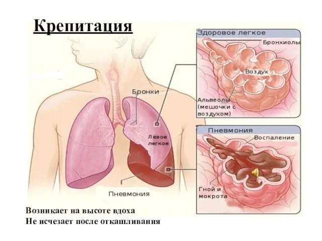 Крепитация Возникает на высоте вдоха Не исчезает после откашливания