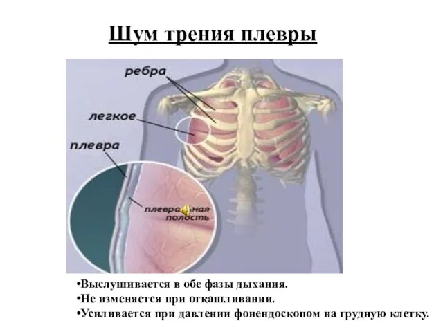 Шум трения плевры Выслушивается в обе фазы дыхания. Не изменяется при