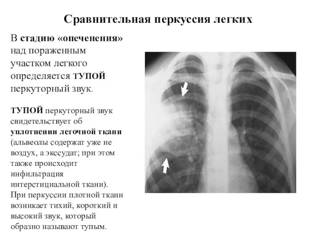 Сравнительная перкуссия легких В стадию «опеченения» над пораженным участком легкого определяется