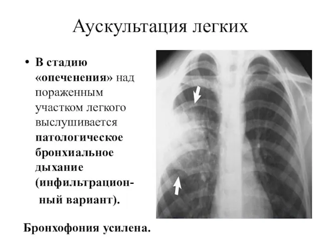 Аускультация легких В стадию «опеченения» над пораженным участком легкого выслушивается патологическое