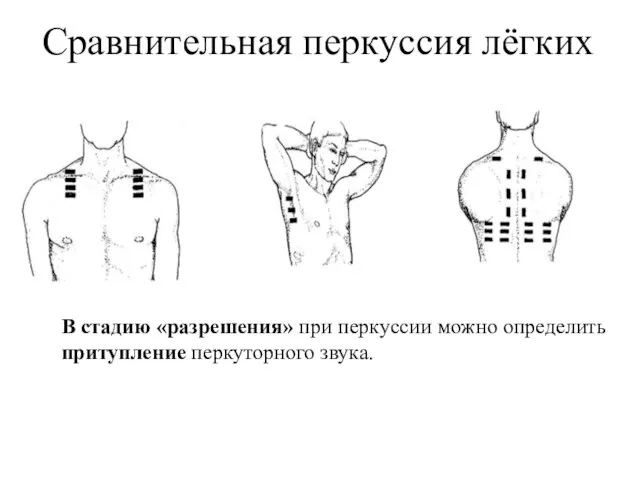 Сравнительная перкуссия лёгких В стадию «разрешения» при перкуссии можно определить притупление перкуторного звука.