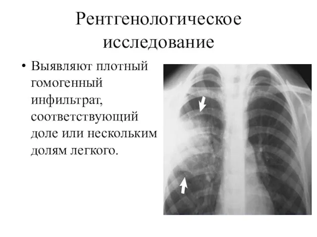 Рентгенологическое исследование Выявляют плотный гомогенный инфильтрат, соответствующий доле или нескольким долям легкого.