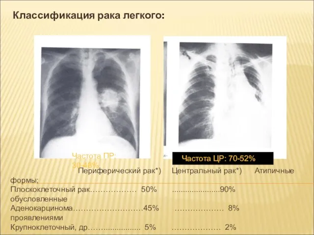 Классификация рака легкого: Периферический рак*) Центральный рак*) Атипичные формы; Плоскоклеточный рак………………