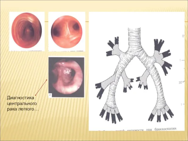 Диагностика центрального рака легкого…