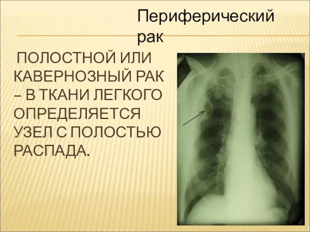 ПОЛОСТНОЙ ИЛИ КАВЕРНОЗНЫЙ РАК – В ТКАНИ ЛЕГКОГО ОПРЕДЕЛЯЕТСЯ УЗЕЛ С ПОЛОСТЬЮ РАСПАДА. Периферический рак