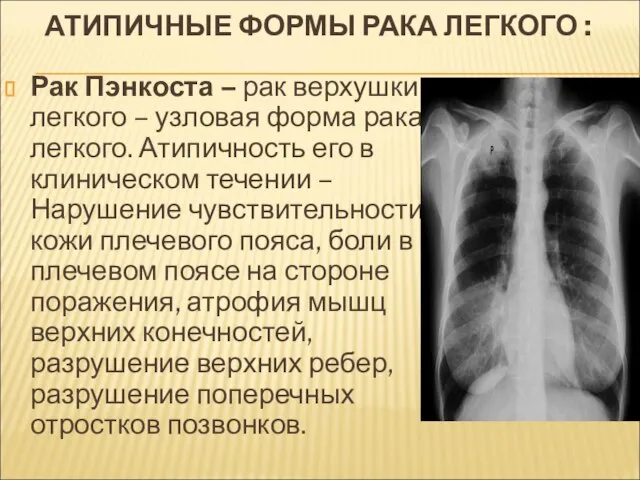 АТИПИЧНЫЕ ФОРМЫ РАКА ЛЕГКОГО : Рак Пэнкоста – рак верхушки легкого