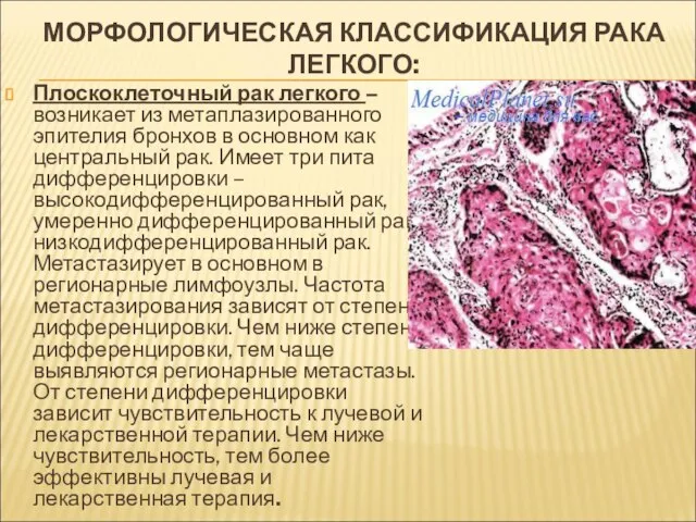 МОРФОЛОГИЧЕСКАЯ КЛАССИФИКАЦИЯ РАКА ЛЕГКОГО: Плоскоклеточный рак легкого – возникает из метаплазированного