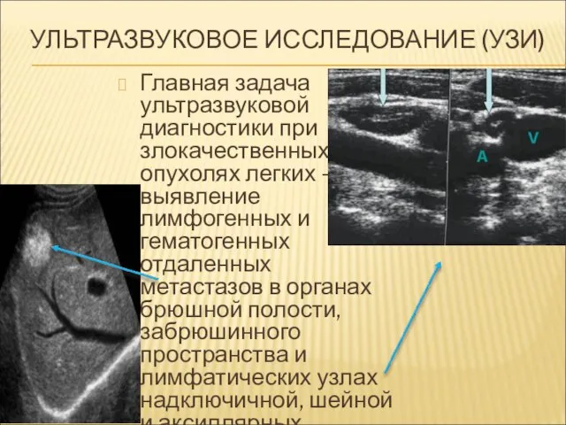 УЛЬТРАЗВУКОВОЕ ИССЛЕДОВАНИЕ (УЗИ) Главная задача ультразвуковой диагностики при злокачественных опухолях легких