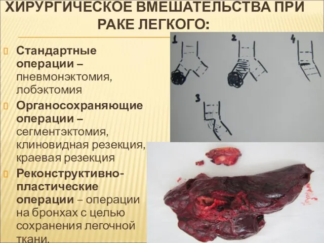 ХИРУРГИЧЕСКОЕ ВМЕШАТЕЛЬСТВА ПРИ РАКЕ ЛЕГКОГО: Стандартные операции – пневмонэктомия, лобэктомия Органосохраняющие