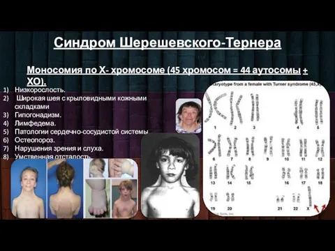 Синдром Шерешевского-Тернера Моносомия по Х- хромосоме (45 хромосом = 44 аутосомы