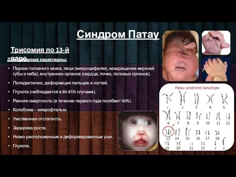 Синдром Патау Трисомия по 13-й паре Для синдрома характерны: Пороки головного