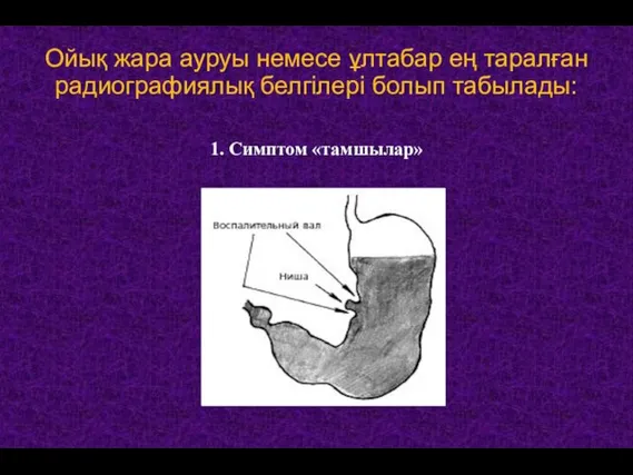 Ойық жара ауруы немесе ұлтабар ең таралған радиографиялық белгілері болып табылады: 1. Симптом «тамшылар»