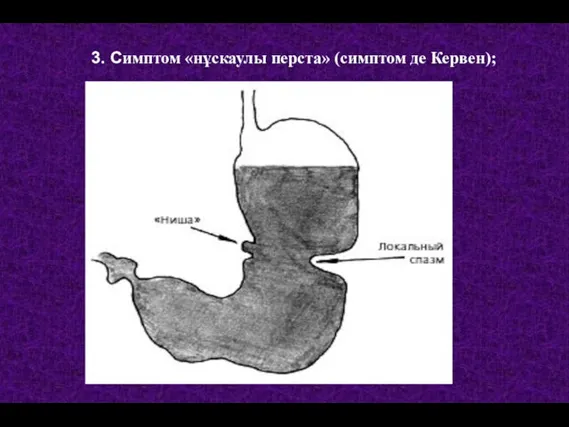 3. Симптом «нұскаулы перста» (симптом де Кервен);