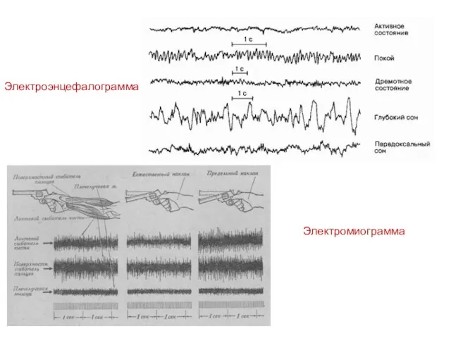 Электроэнцефалограмма Электромиограмма