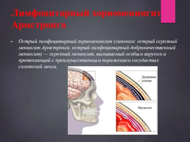 Лимфоцитарный хориоменингит Армстронга Острый лимфоцитарный хориоменингит (синоним: острый серозный менингит Армстронга,