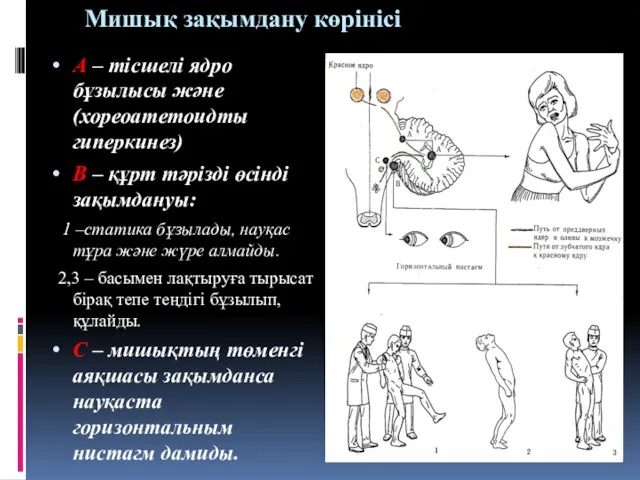 Мишық зақымдану көрінісі А – тісшелі ядро бұзылысы және (хореоатетоидты гиперкинез)