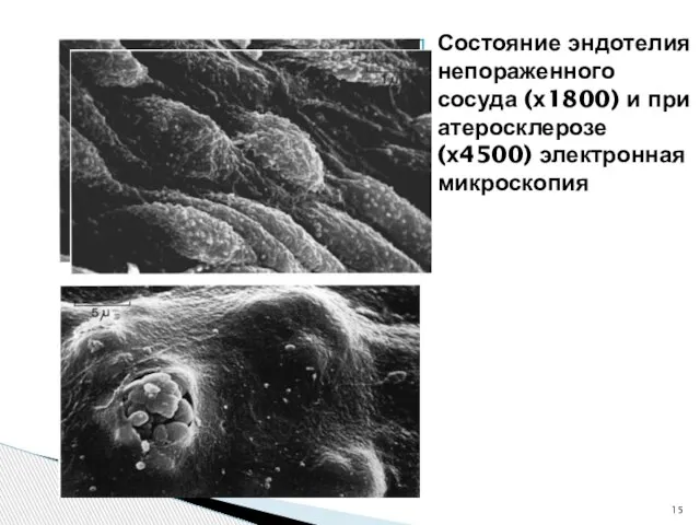 Состояние эндотелия непораженного сосуда (х1800) и при атеросклерозе (х4500) электронная микроскопия