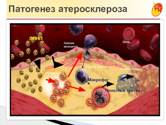 Патогенез атеросклероза Кровь ЛПНП Модификация Макрофаг Адгезия моноцитов Гладкие мышцы Пенистые клетки Воспалительная реакция