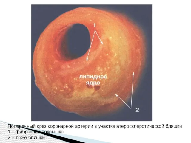 Поперечный срез коронарной артерии в участке атеросклеротической бляшки 1 – фиброзная покрышка; 2 – ложе бляшки