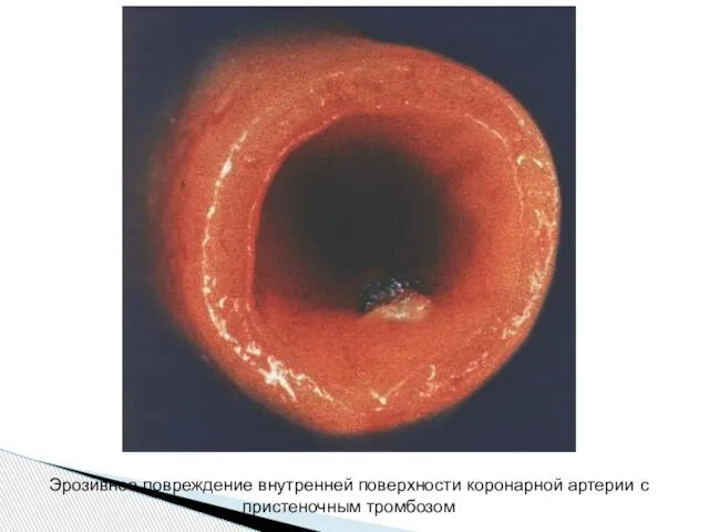 Эрозивное повреждение внутренней поверхности коронарной артерии с пристеночным тромбозом