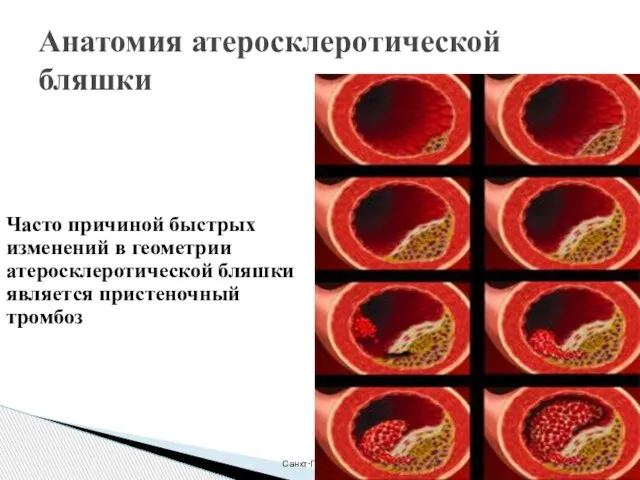 Санкт-Петербургский Центр последипломного образования Анатомия атеросклеротической бляшки Часто причиной быстрых изменений