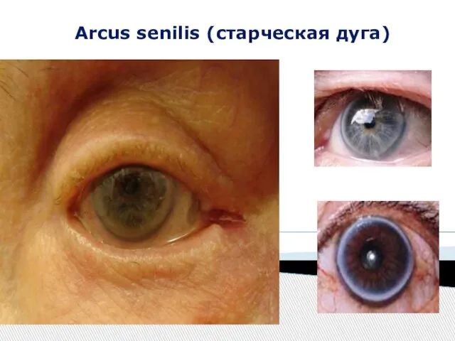 Arcus senilis (старческая дуга)