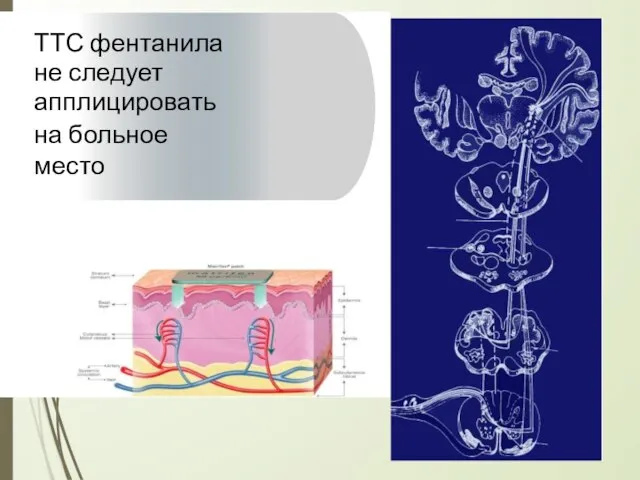 ТТС фентанила не следует апплицировать на больное место