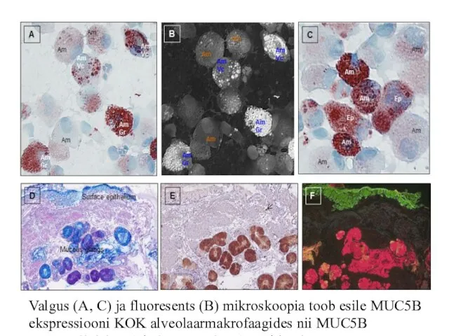 Valgus (A, C) ja fluoresents (B) mikroskoopia toob esile MUC5B ekspressiooni