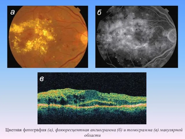 Цветная фотография (а), флюоресцентная ангиограмма (б) и томограмма (в) макулярной области а б в
