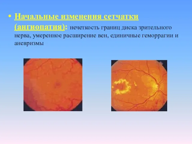 Начальные изменения сетчатки (ангиопатия): нечеткость границ диска зрительного нерва, умеренное расширение вен, единичные геморрагии и аневризмы