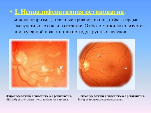 I. Непролиферативная ретинопатия: микроаневризмы, точечные кровоизлияния, отёк, твердые экссудативные очаги в