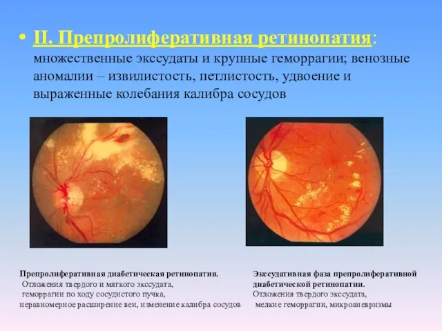 II. Препролиферативная ретинопатия: множественные экссудаты и крупные геморрагии; венозные аномалии –