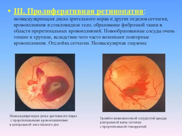 III. Пролиферативная ретинопатия: неоваскуляризация диска зрительного нерва и других отделов сетчатки,