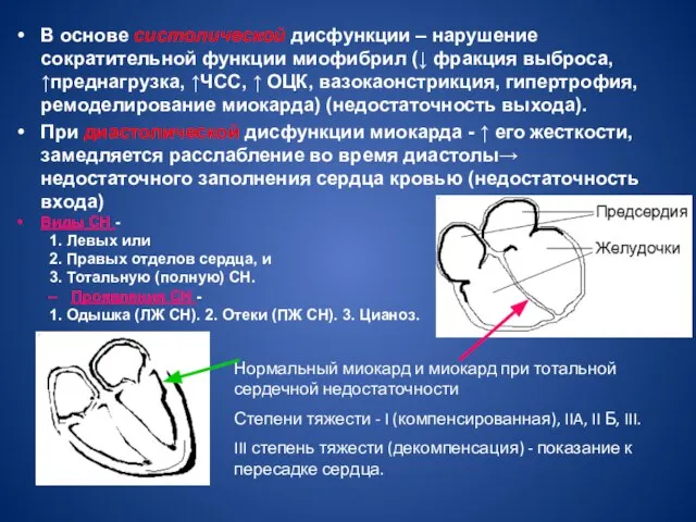 В основе систолической дисфункции – нарушение сократительной функции миофибрил (↓ фракция