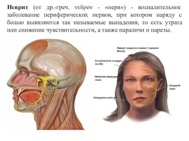 Неврит (от др.-греч. νεῦρον - «нерв») - воспалительное заболевание периферических нервов,