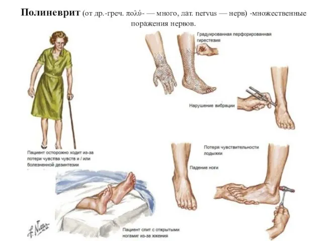 Полиневрит (от др.-греч. πολύ- — много, лат. nervus — нерв) -множественные поражения нервов.