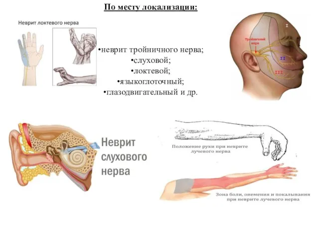 По месту локализации: •неврит тройничного нерва; •слуховой; •локтевой; •языкоглоточный; •глазодвигательный и др.