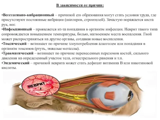 В зависимости от причин: •Вегетативно-вибрационный – причиной его образования могут стать