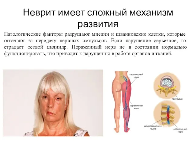 Неврит имеет сложный механизм развития Патологические факторы разрушают миелин и шванновские