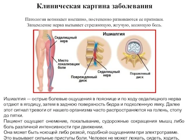 Клиническая картина заболевания Патология возникает внезапно, постепенно развиваются ее признаки. Защемление