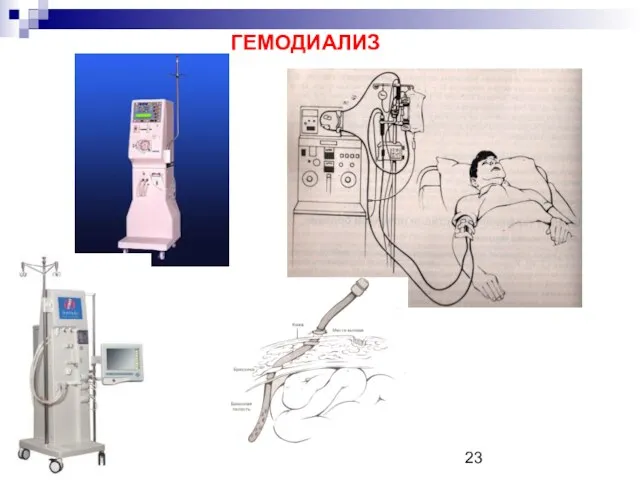 ГЕМОДИАЛИЗ