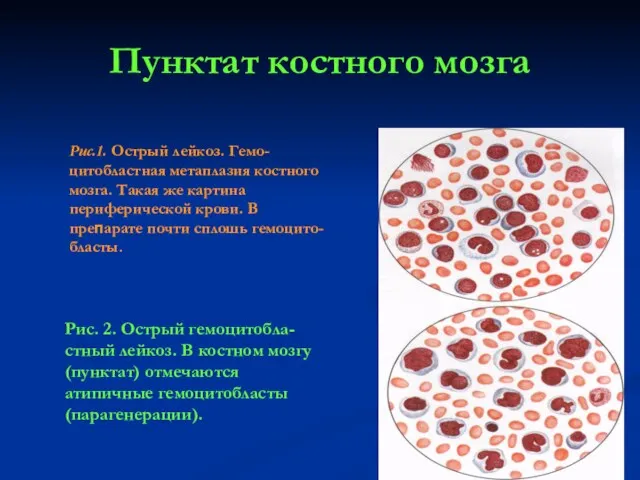 Пунктат костного мозга Рис.1. Острый лейкоз. Гемо-цитобластная метаплазия костного мозга. Такая