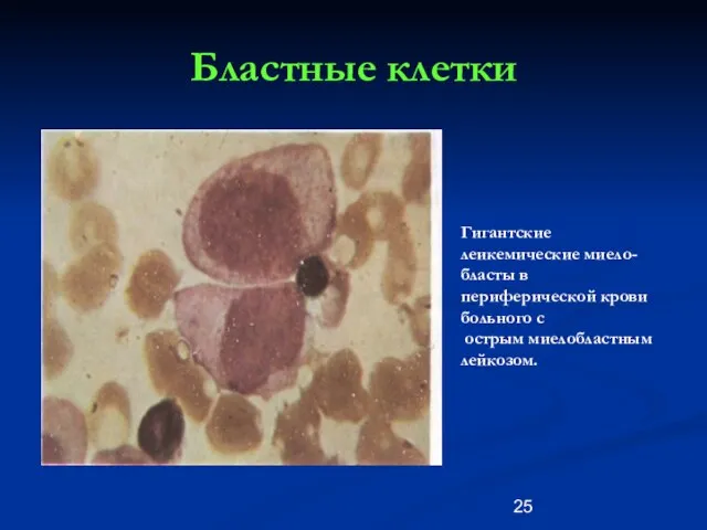 Бластные клетки Гигантские леикемические миело-бласты в периферической крови больного с острым миелобластным лейкозом.