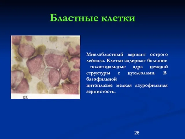 Бластные клетки Миелобластный вариант острого лейкоза. Клетки содержат большие полигональные ядра