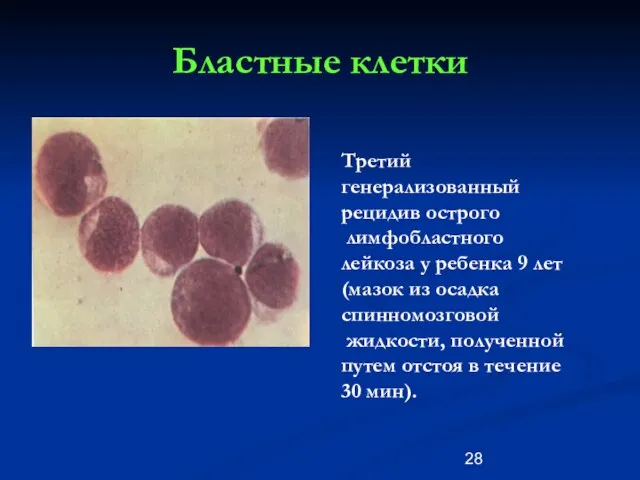 Бластные клетки Третий генерализованный рецидив острого лимфобластного лейкоза у ребенка 9