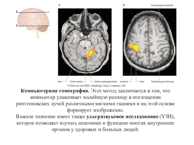 Компьютерная томография. Этот метод заключается в том, что компьютер улавливает малейшую