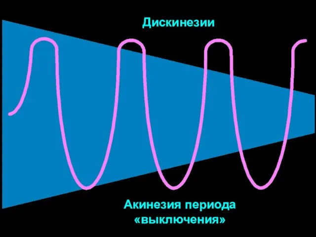 Дискинезии Акинезия периода «выключения»