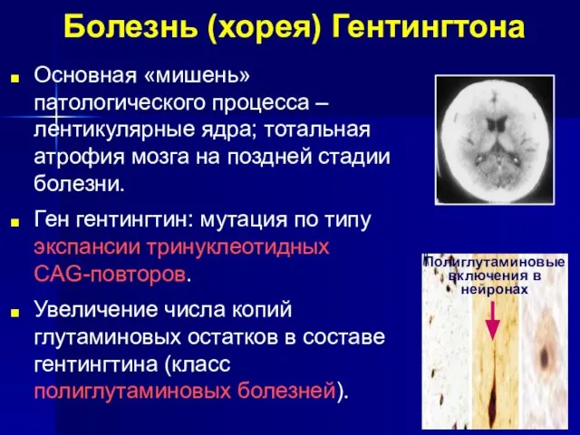 Болезнь (хорея) Гентингтона Основная «мишень» патологического процесса – лентикулярные ядра; тотальная